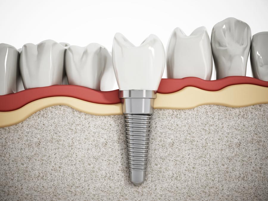 implantes-dentales-riesgos