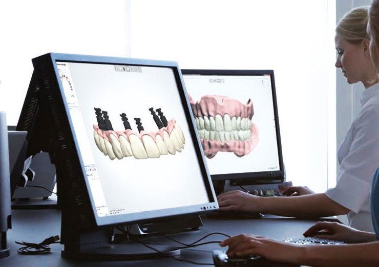 Planificación 3D para implantes dentales Planificación 3D para implantes dentales