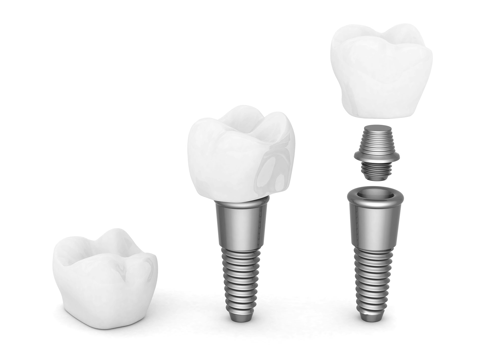implantes-dentales-tipos