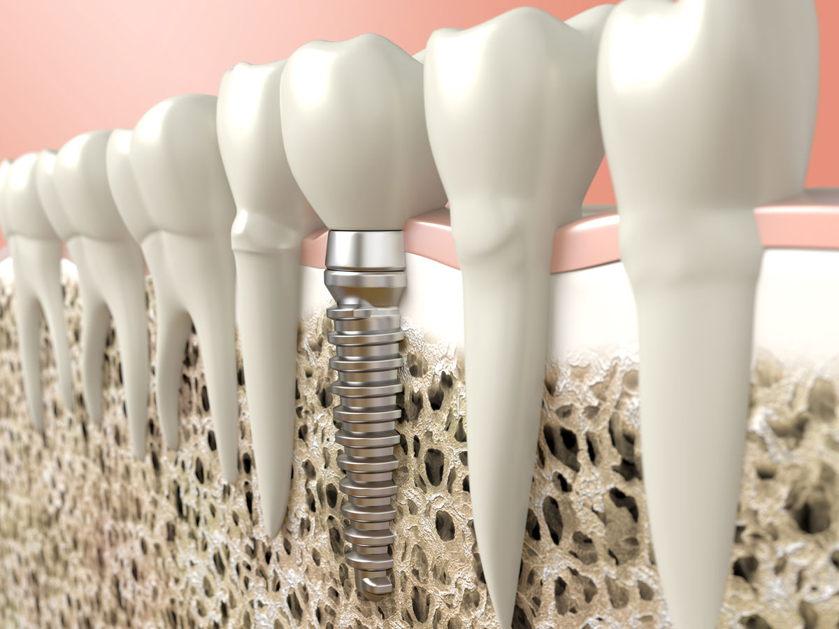 Técnicas de colocación en implantes dentales