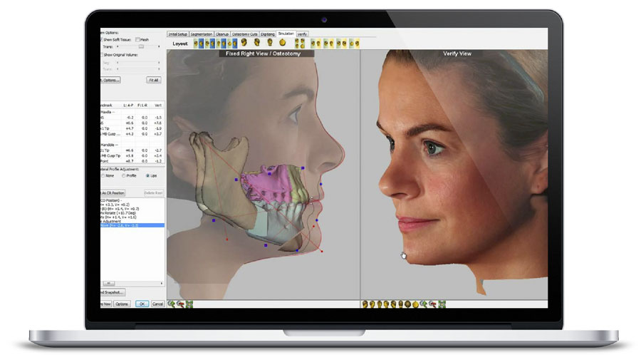 Simulación 3D en cirugía facial