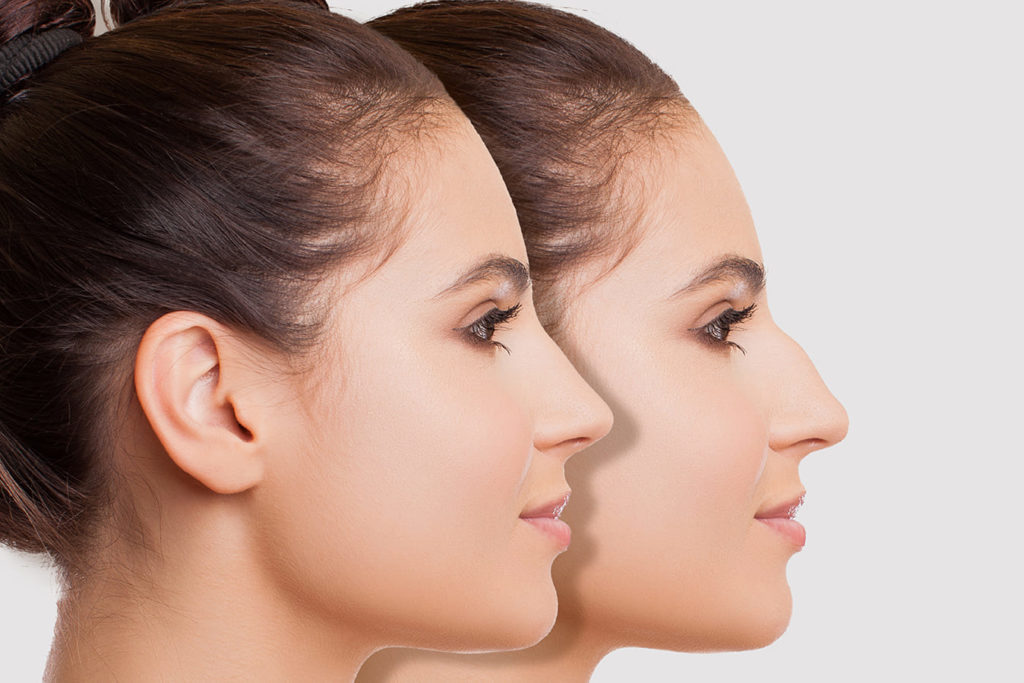 rinoplastia secundaria