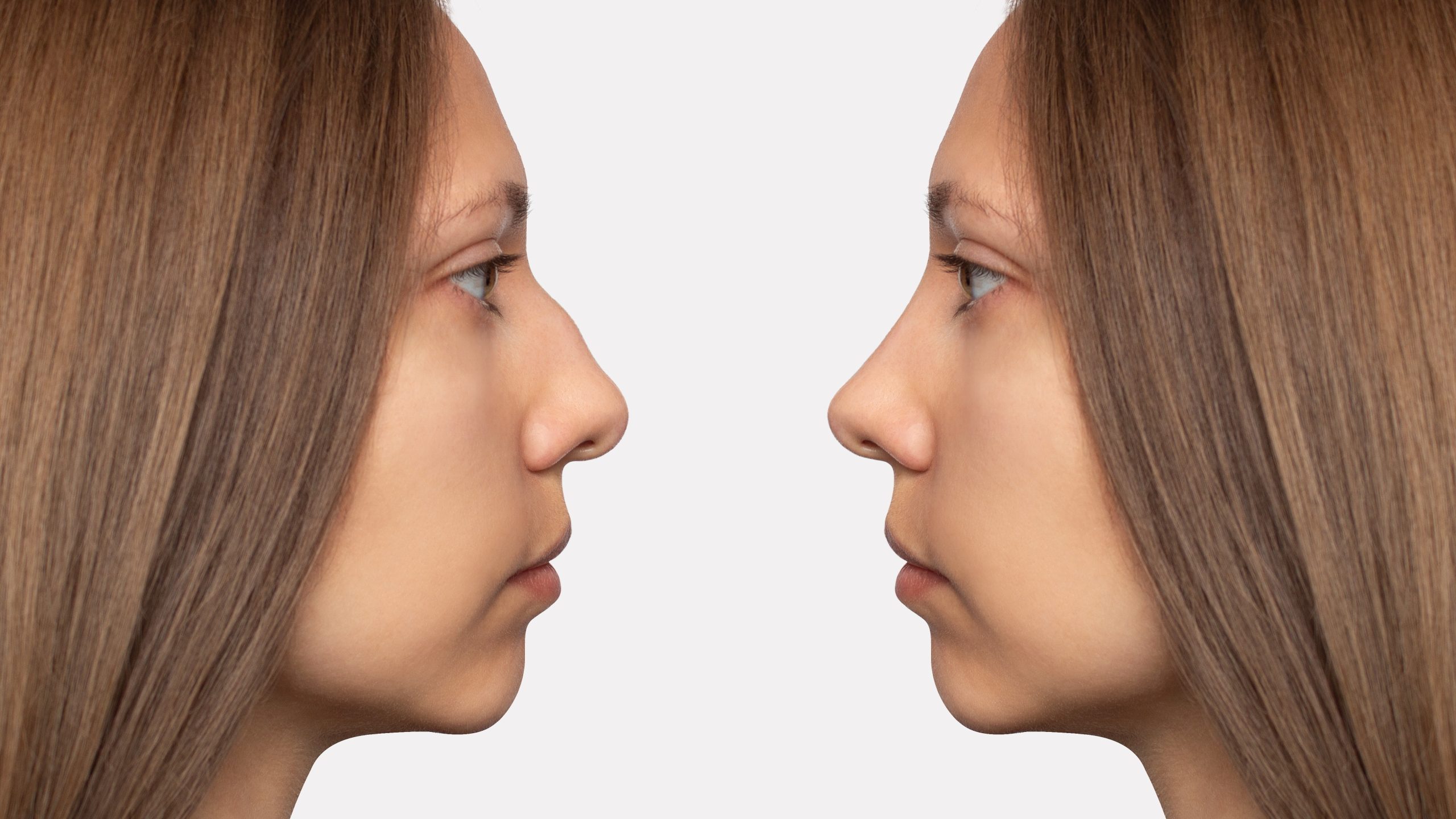 comparativa rinoplastia